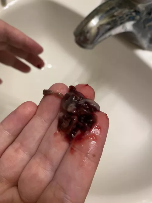 1 week post op from extensive sinus surgery. This just came out of my nose by purplefrog130