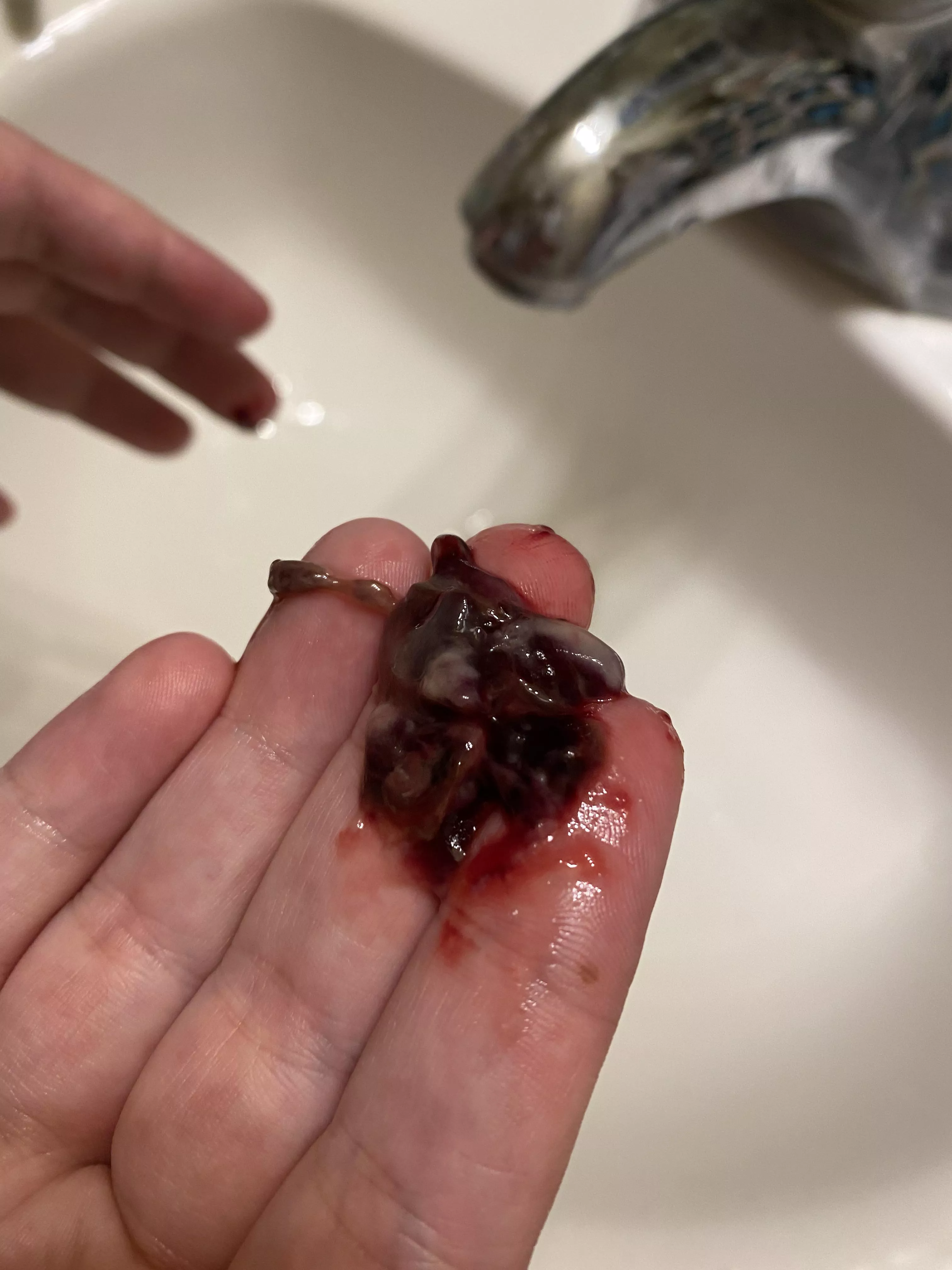 1 week post op from extensive sinus surgery. This just came out of my nose posted by purplefrog130