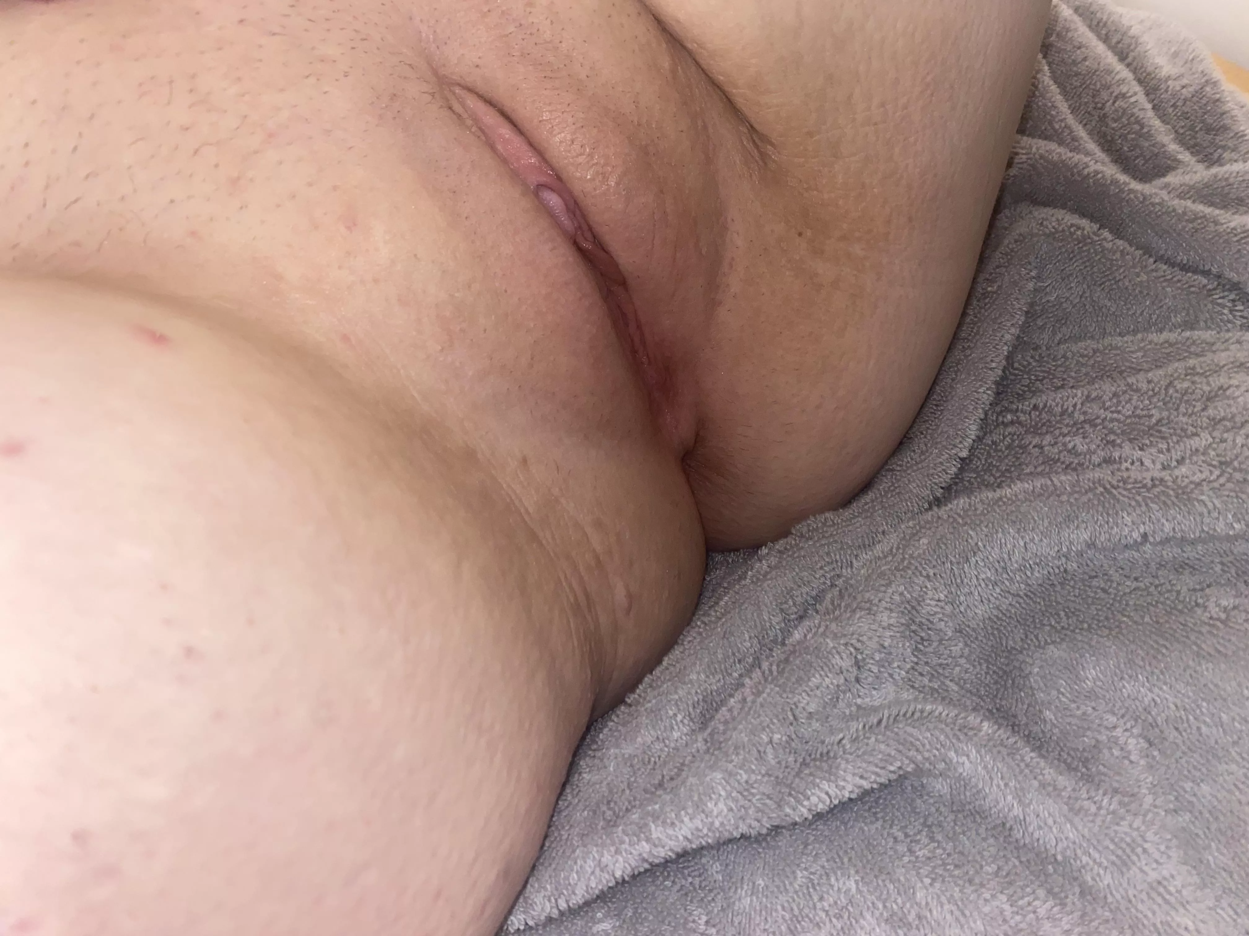 25•197• 5”6 came a long way with hyperpigmentation, definitely don’t mind the spread these days 🥰 posted by PretendMongoose9113