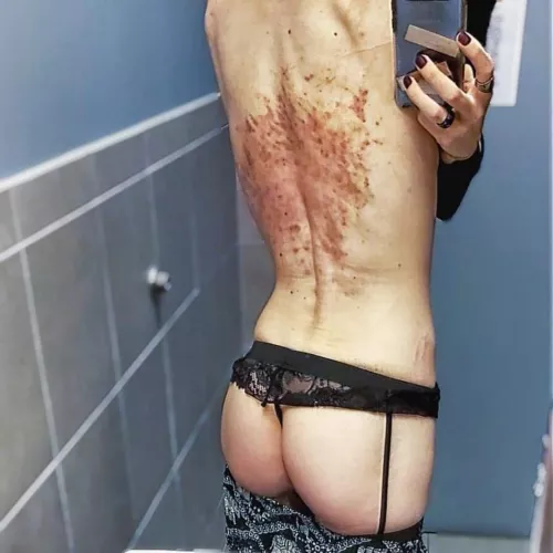 300 lashings and 24 hours later... it's still warm to the touch. sensitive and sore but looks much worse than it actually feels. by TheBirdinChains