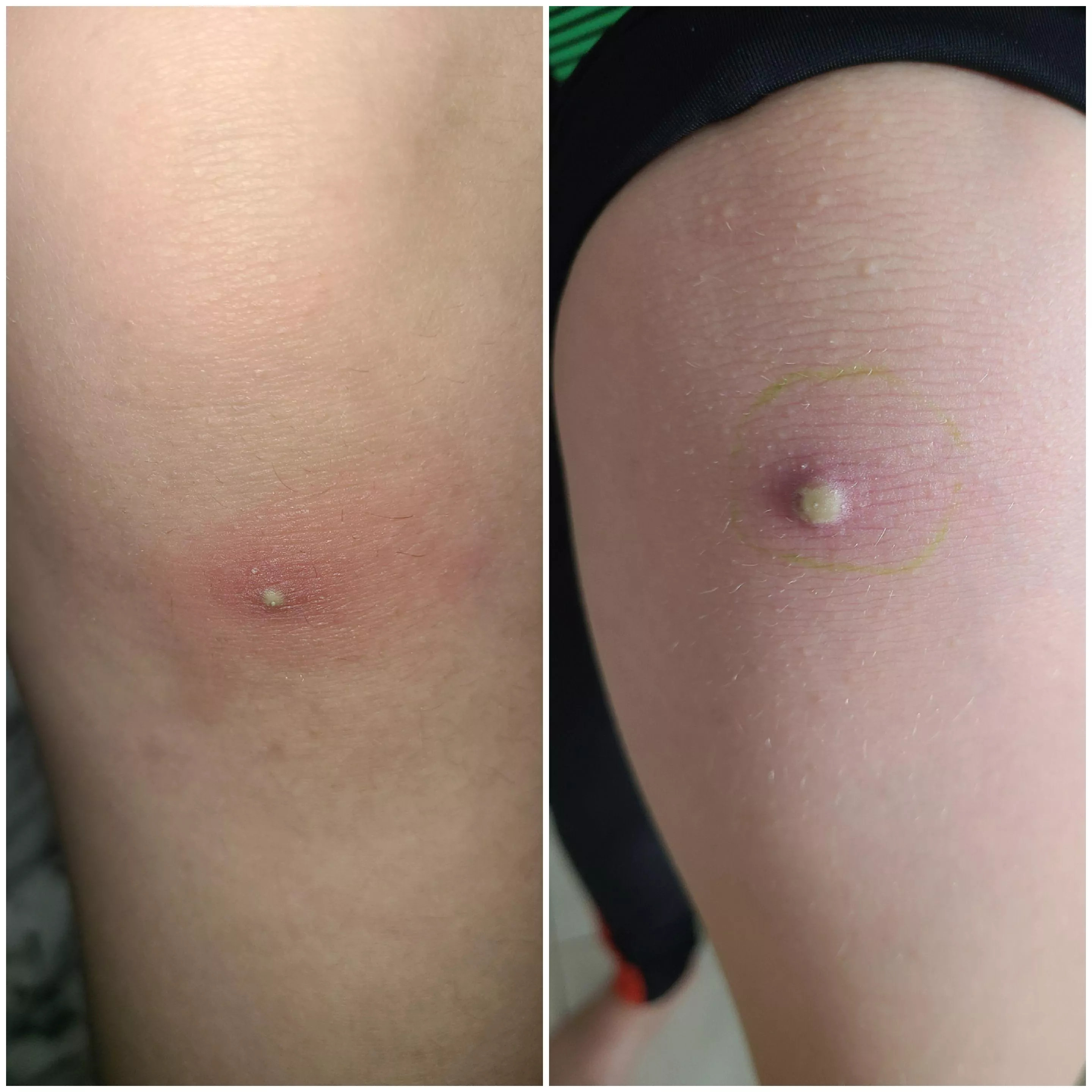 9 year old has this right below the knee.. pics taken 3 days apart. I'm not sure what it could be?! Figured this group might know posted by RghtPeesed