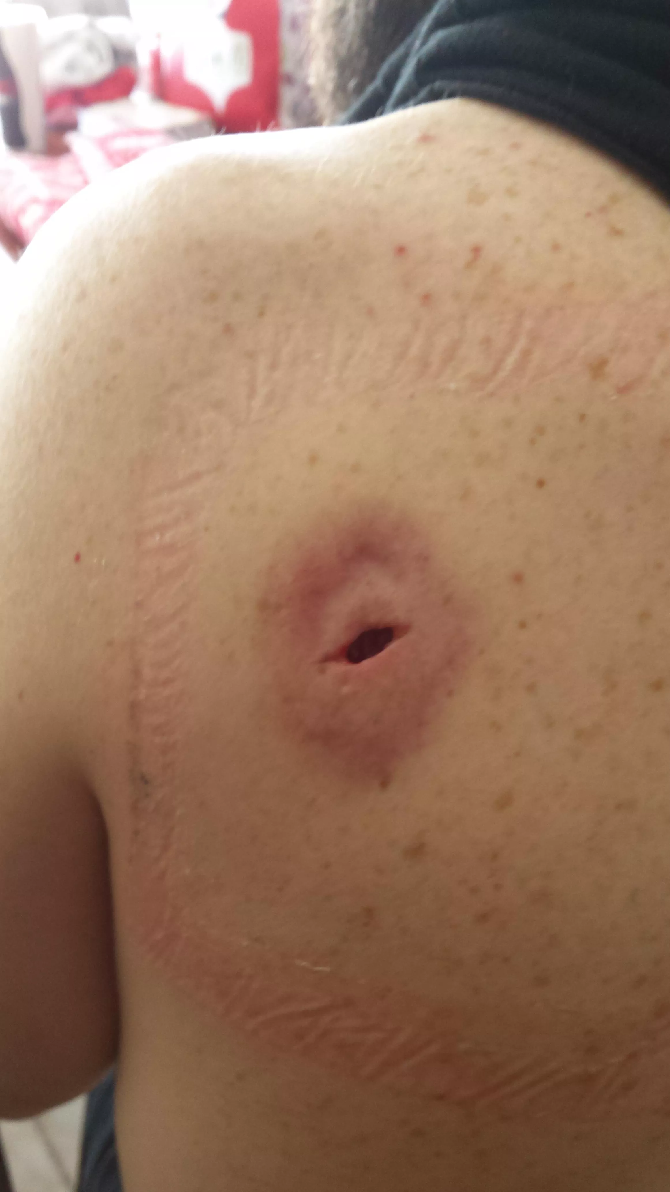 A couple days after the removal of a golf ball size cyst from the shoulder. posted by impressive_specimen