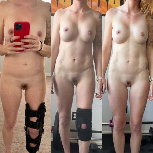 A different OnOff today. Broke my leg and here is my progress to being brace free!! (F33) by Fitcouple