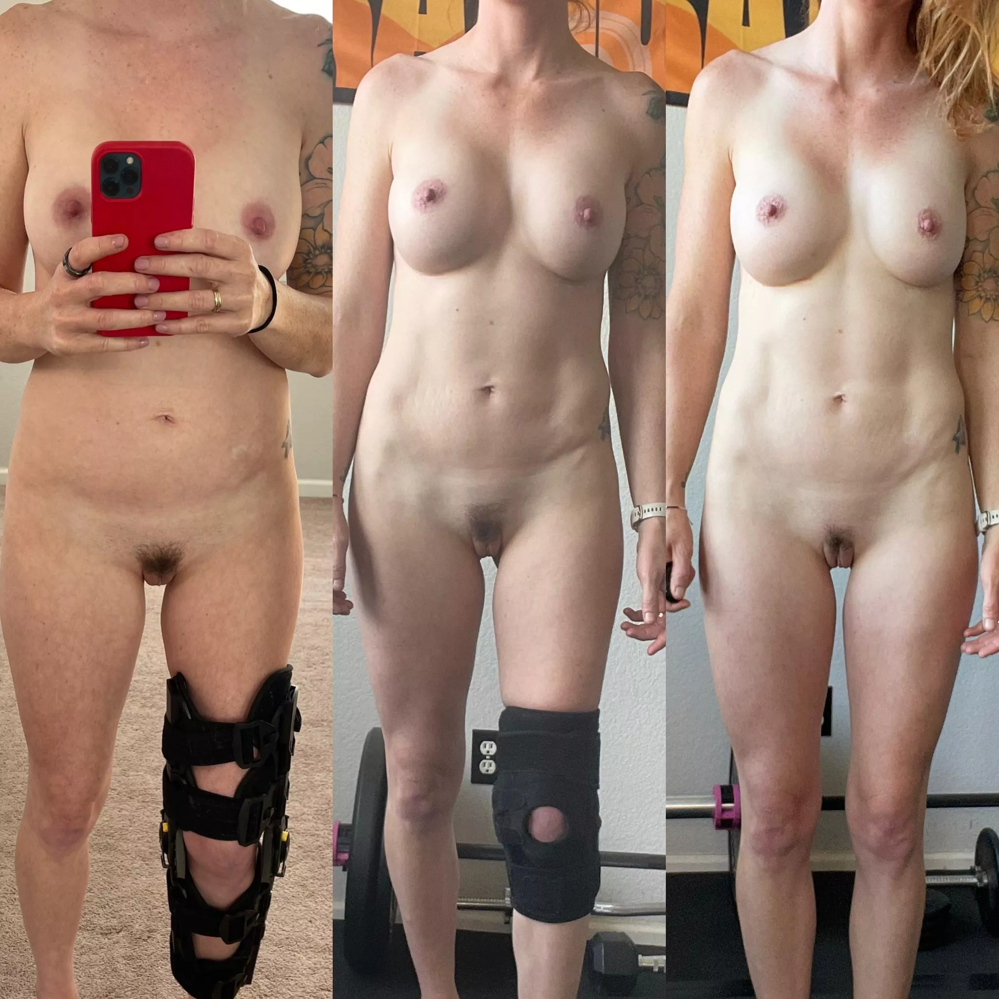 A different OnOff today. Broke my leg and here is my progress to being brace free!! (F33) posted by Fitcouple