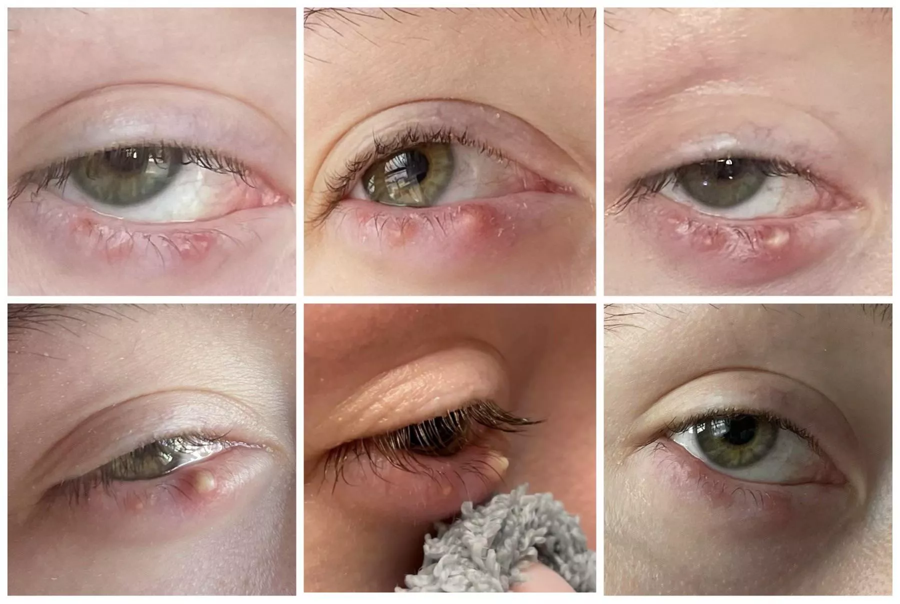 A look back at the progression of the stye I’m still battling a year later. posted by popcorn-bag-girl