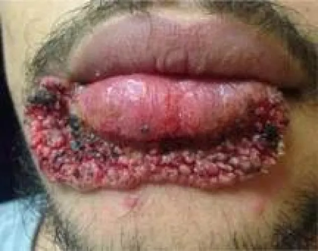 Always use clean tools! Credit to r/medicalgore, for some reason I couldn't xpost. by EssLivesAgain