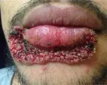 Always use clean tools! Credit to r/medicalgore, for some reason I couldn't xpost. posted by EssLivesAgain