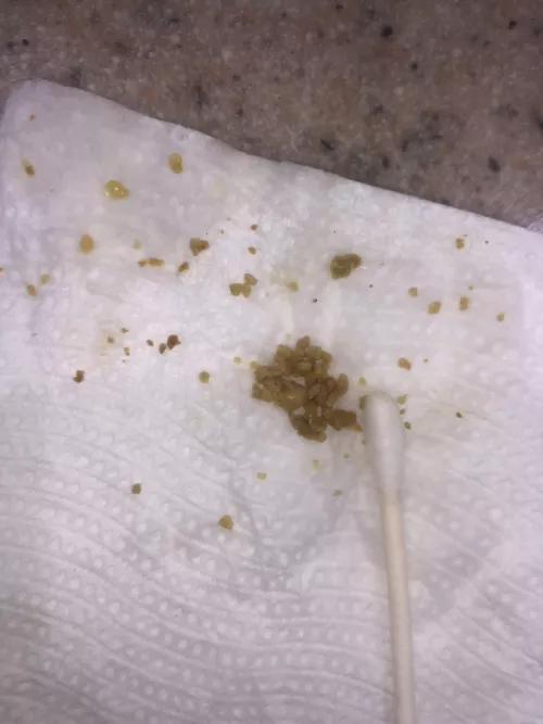 And the stones are still coming out 🤮 by rpr33