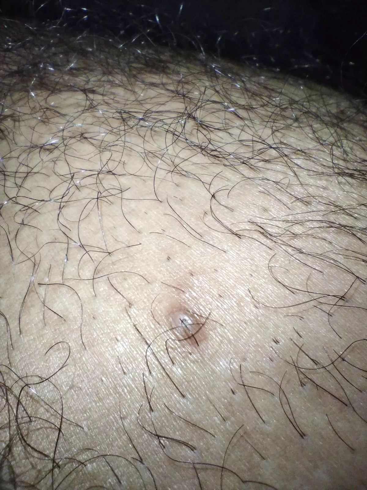 Another one_ Ingrown hair posted by fowfowback60