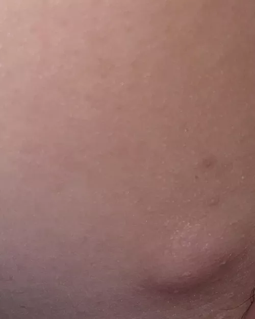 Any idea what this is? I’ve been to the doctor about two years ago and she said it felt okay. It’s got bigger since and hurts more. It’s on the inner side of my groin/leg. by whisperingocean
