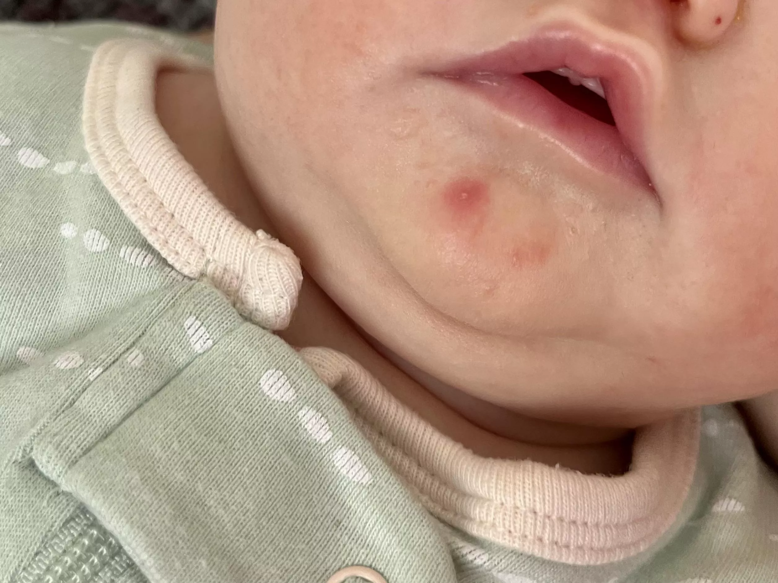 Baby acne: Forbidden pop posted by bonnieprincetearlach