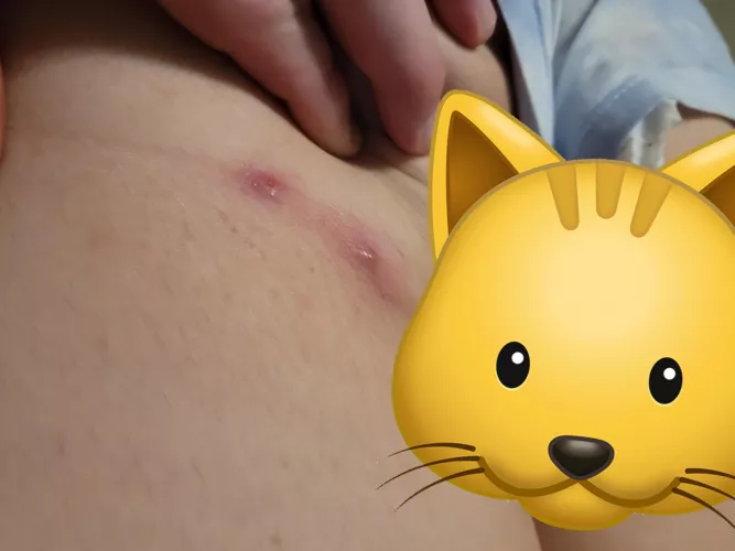 been a lurker for a while. found these last night under by buttcheek, the pop was painful. by Little_Enby_Bean_96