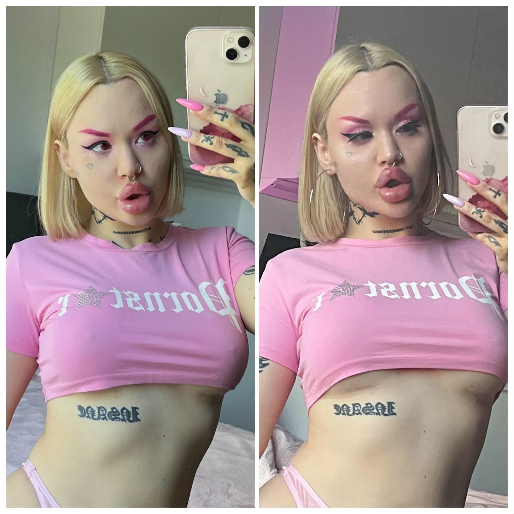 Before and after lip and face fillers, few hours difference posted by nasty_bimbo
