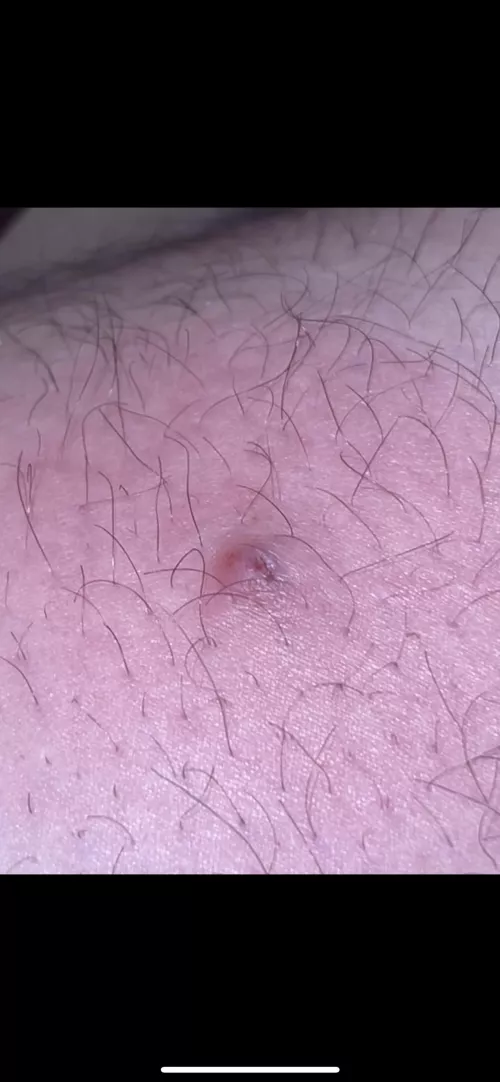 Before I rush to ER is this a spider bite or an ingrown hair? Hurts pretty darn bad. by Panhandlemantle
