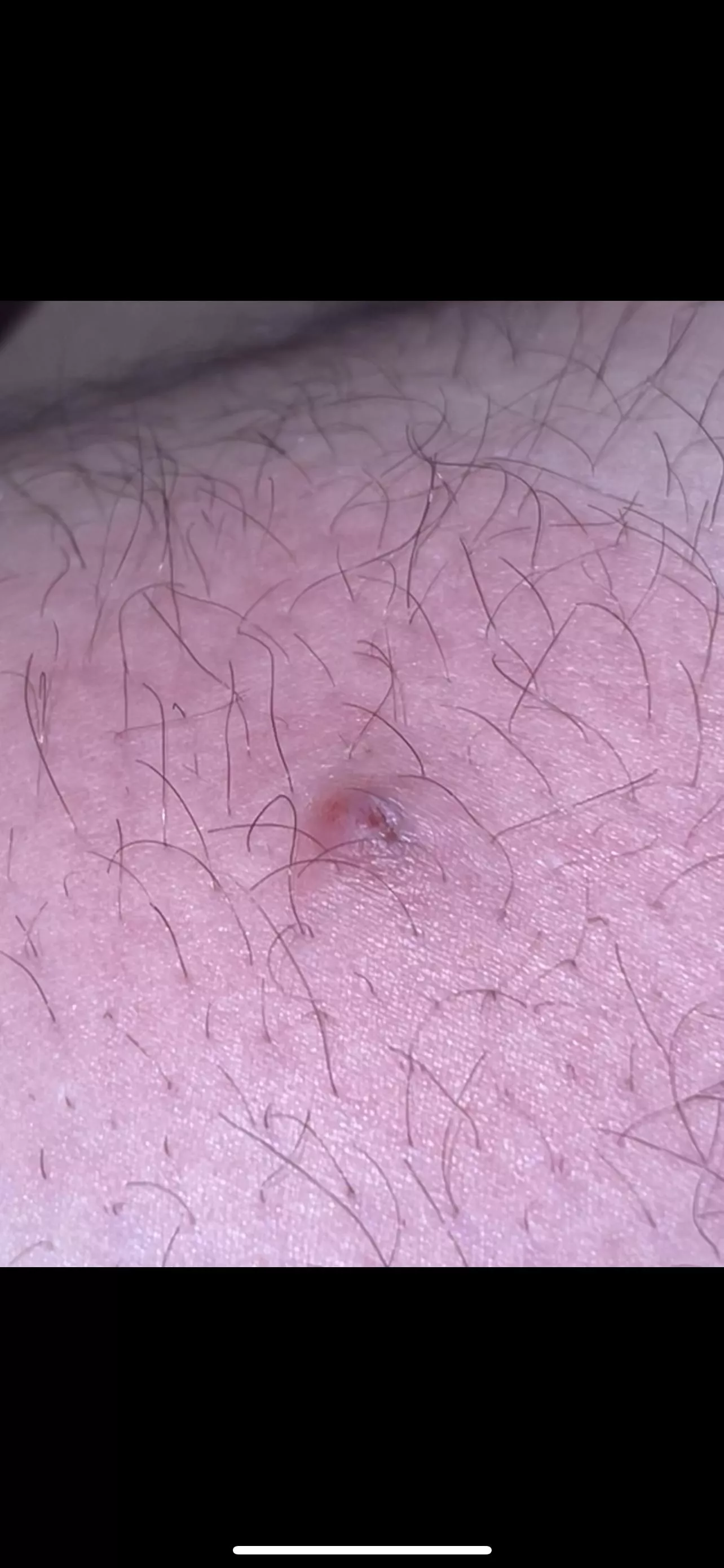 Before I rush to ER is this a spider bite or an ingrown hair? Hurts pretty darn bad. posted by Panhandlemantle
