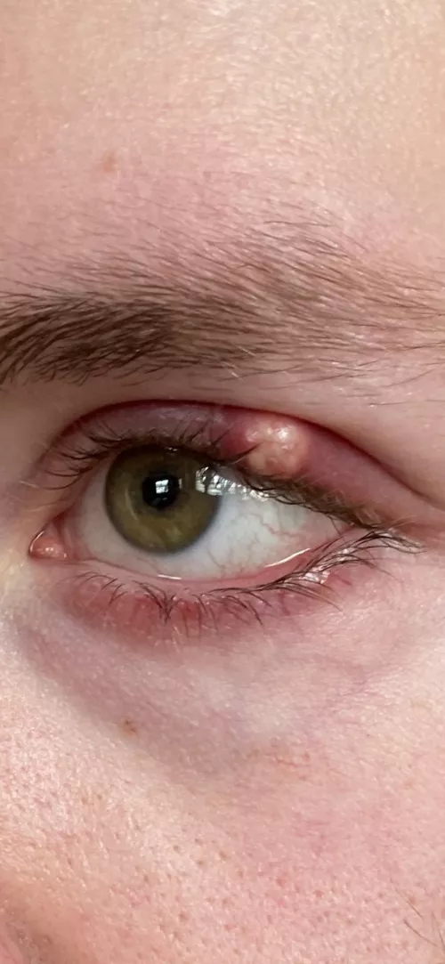 Biggest stye I’ve ever had I’m trying to fight the urge to drain it myself by Bucear