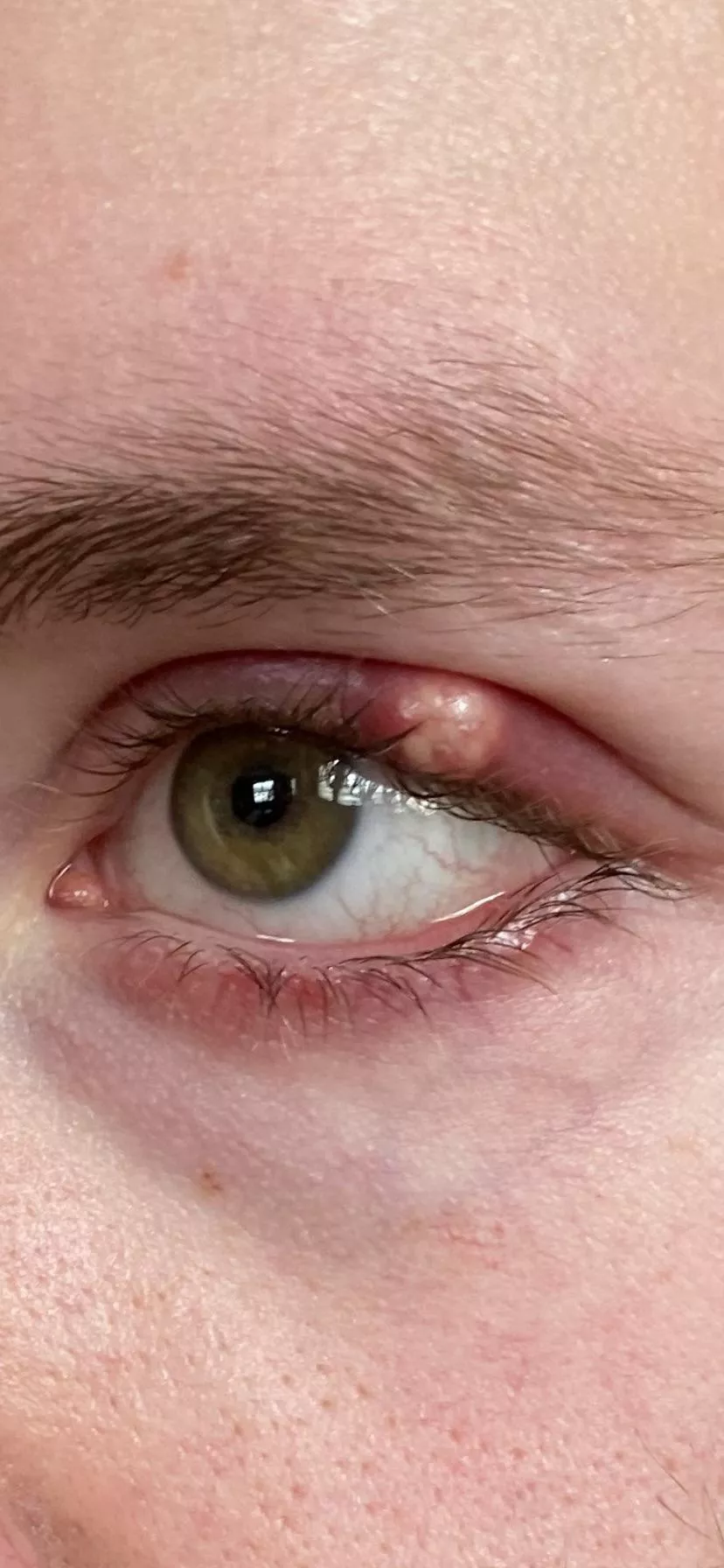 Biggest stye I’ve ever had I’m trying to fight the urge to drain it myself posted by Bucear