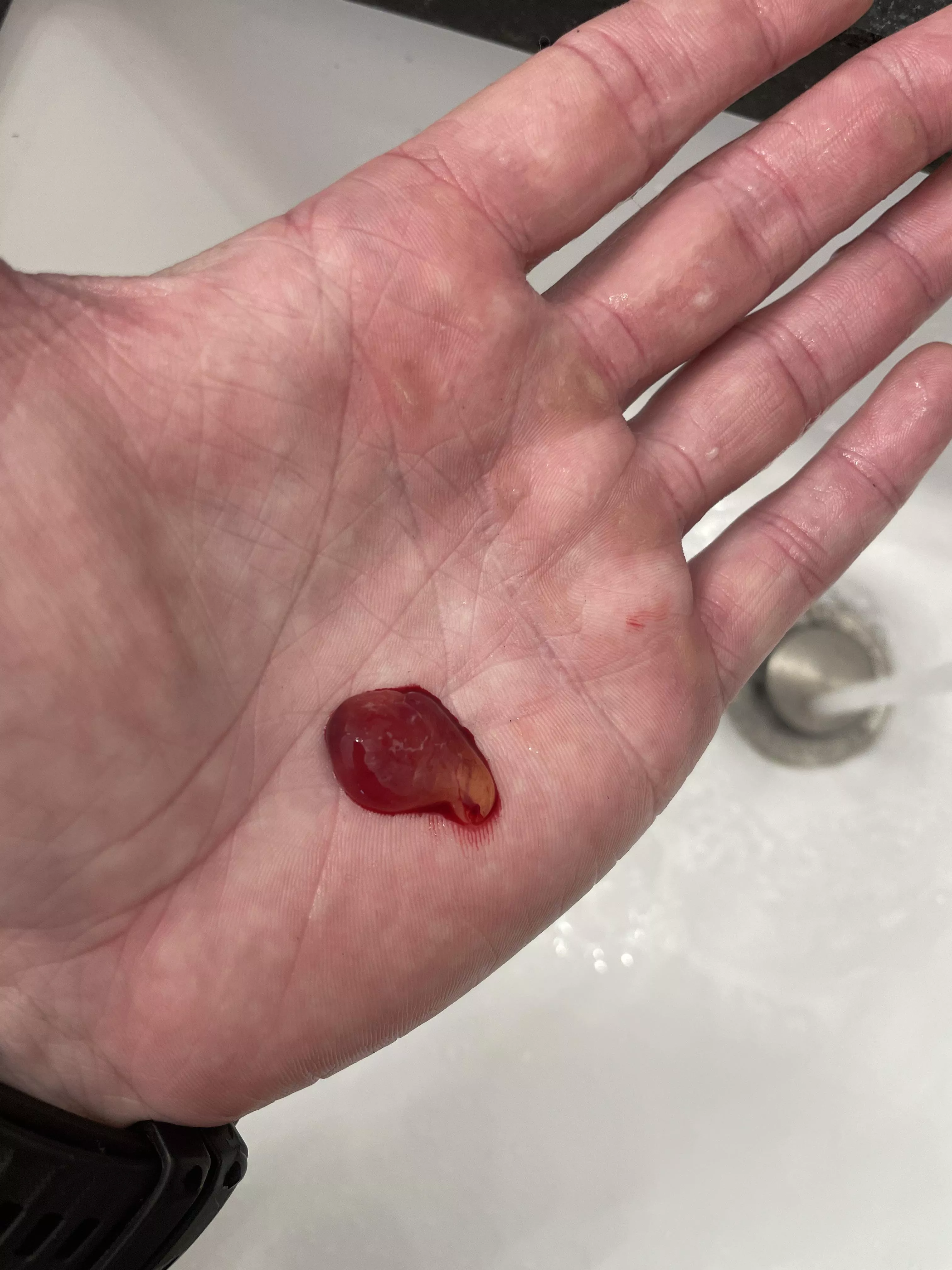 Blew this out of my nose this morning. Then epistaxis followed. Consistency of a fruit chew, but I could breathe so well! posted by PalpateMe