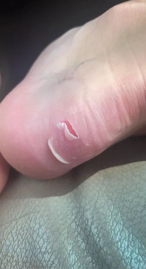 Blister I formed on my heel from steel toe boots. Felt it pop this morning. by kmills_11