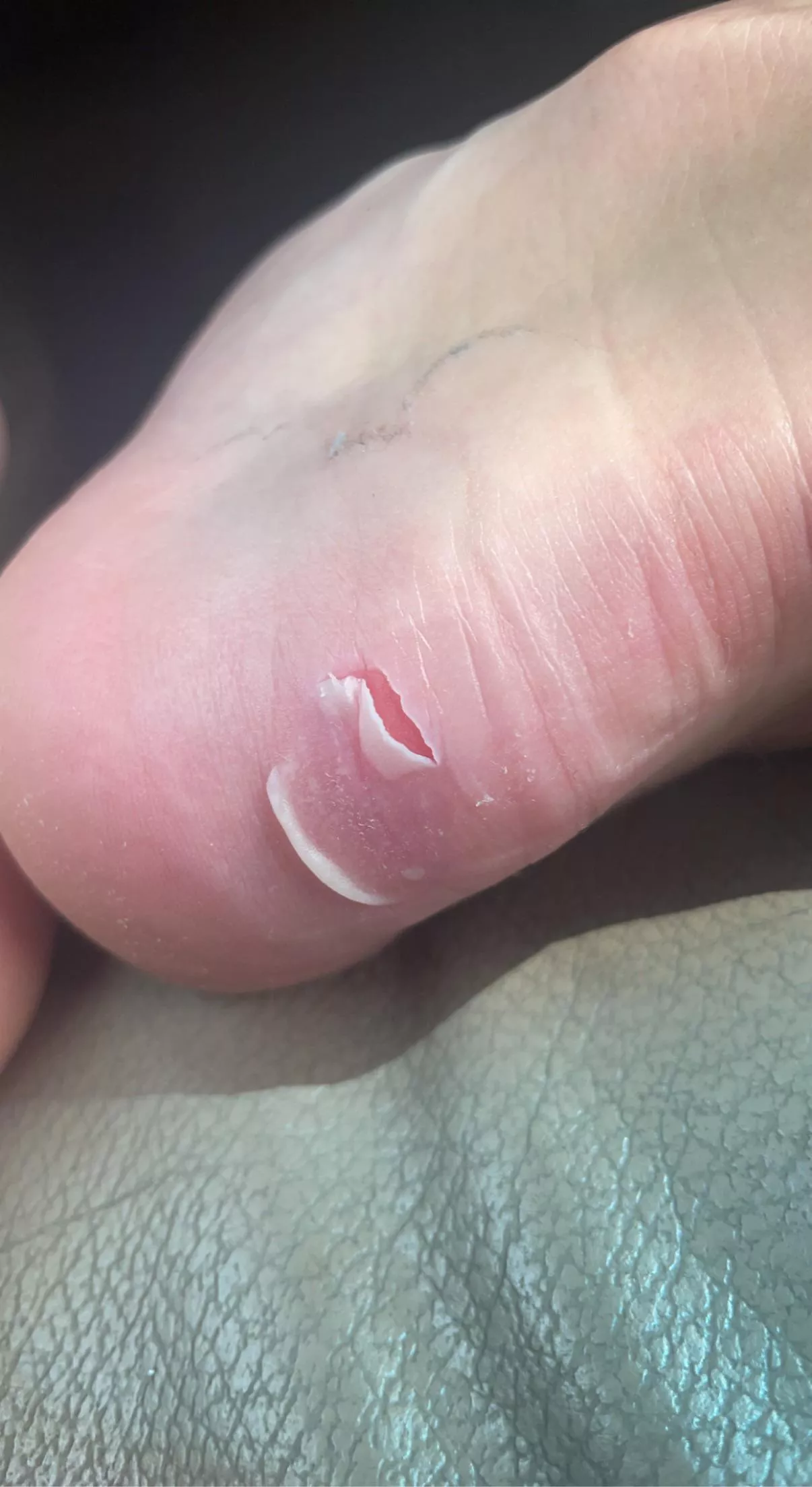 Blister I formed on my heel from steel toe boots. Felt it pop this morning. posted by kmills_11