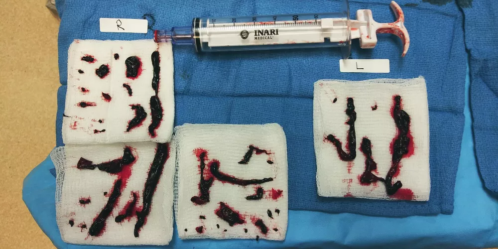 Blood clots removed from my lungs via suction by KnightPisces