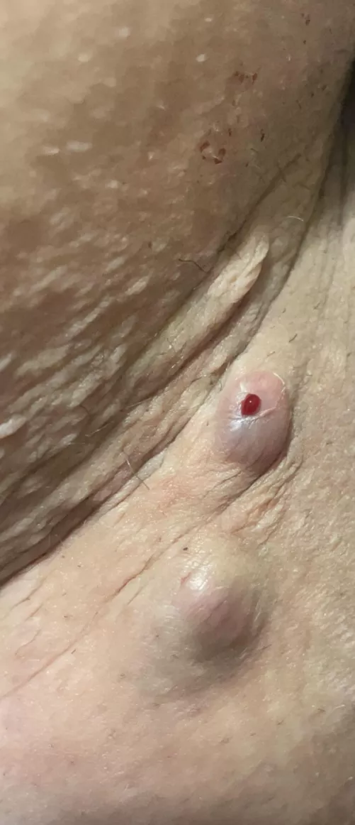 Boils on inner thigh/ butt area that I always get. They typically drain by themselves, super painful tho :/ by Neat_Education