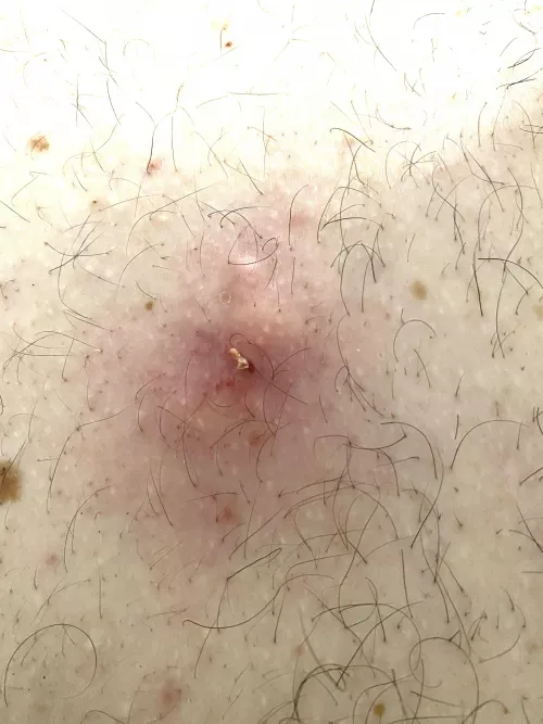 Boyfriend had a massive thing on his back and this fellow came out. I think we're parents now. by graceful_ace