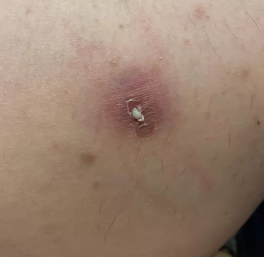 Boyfriend just got this baby off of my leg. by Nicholeeef