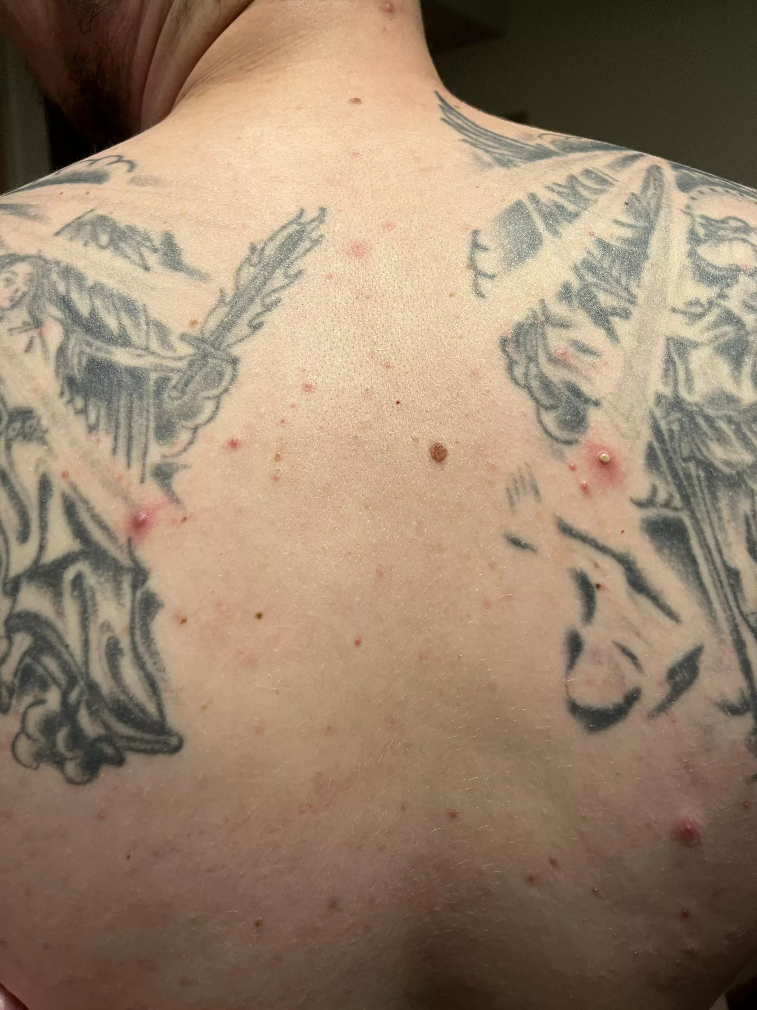 Boyfriend said he had some gold mines on his back tonight, I would agree 😅 Didn’t film any popping unfortunately but all of the pops were anticlimactic anyways 😂 posted by laurS5