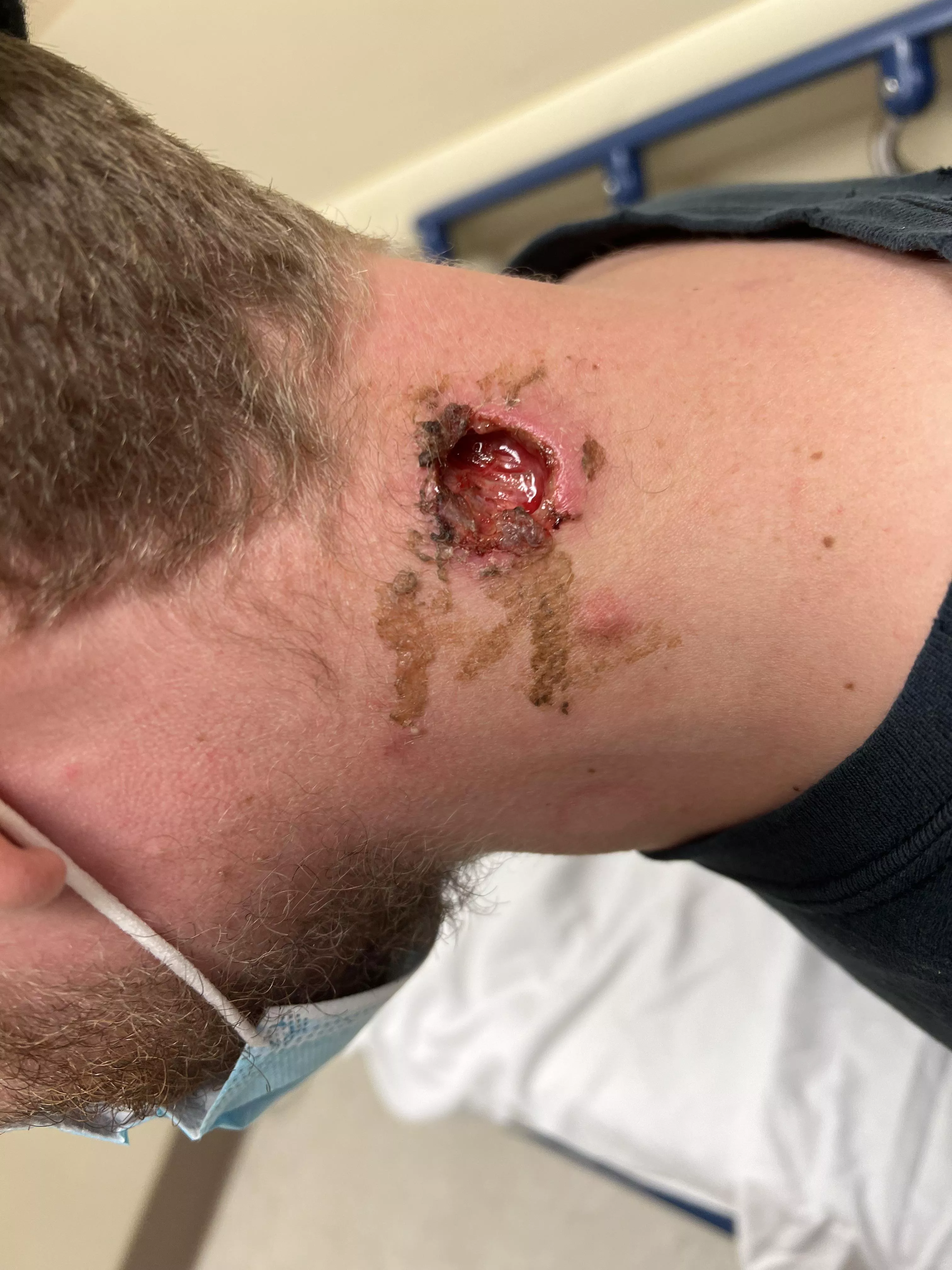Brothers neck cyst was removed and the glue holding it together busted open. Gnarly. posted by ZazzooGaming