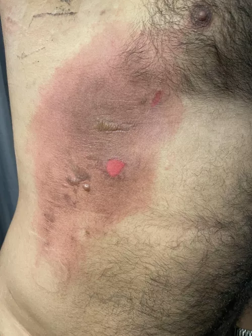 Burn update, poor guy! by AbaloneComfortable22