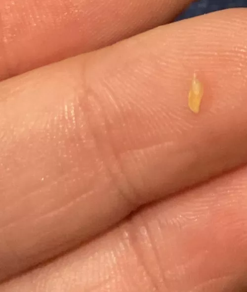 Came out of my scalp by nicksbrunchattiffany