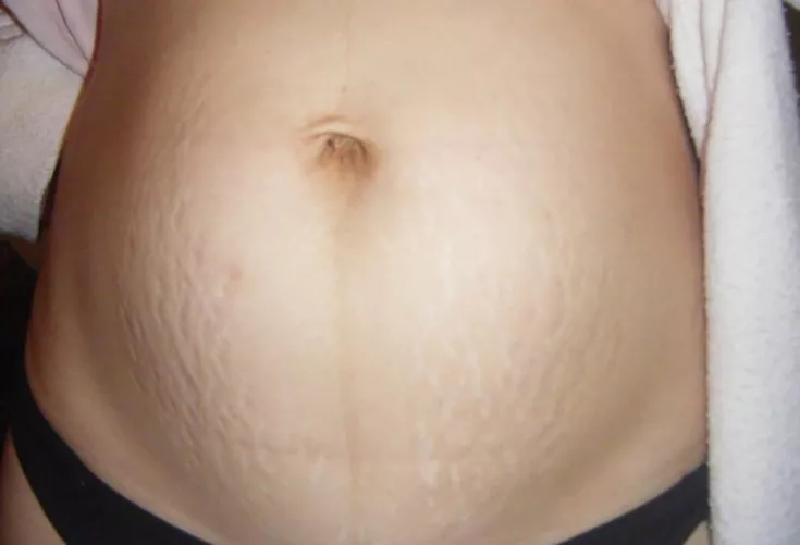 Can share code any idol that she ever gave birth and her body has belly strech please ?? by prelileng