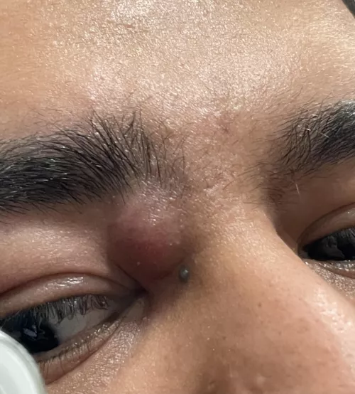 Can't really afford to go the doctor right now, what is this? Can I pop it myself? by lmaogtfo