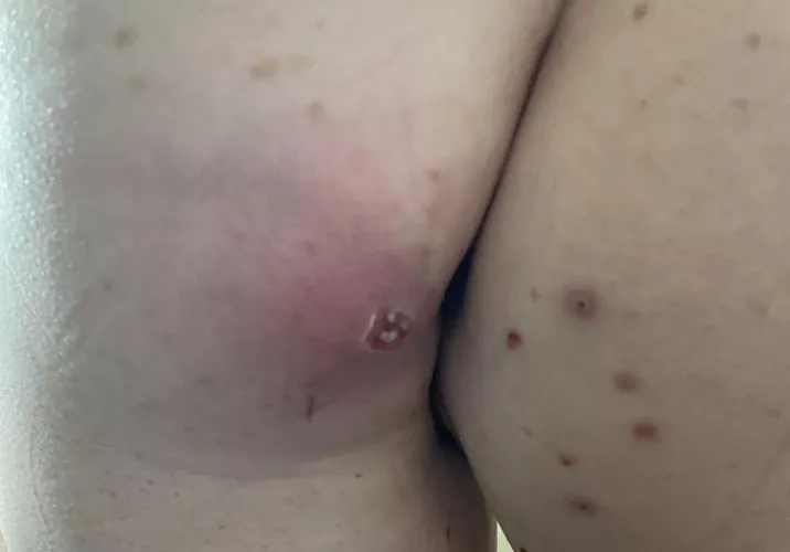 Carbuncle on butt ft. butt pimples by goofygirly1