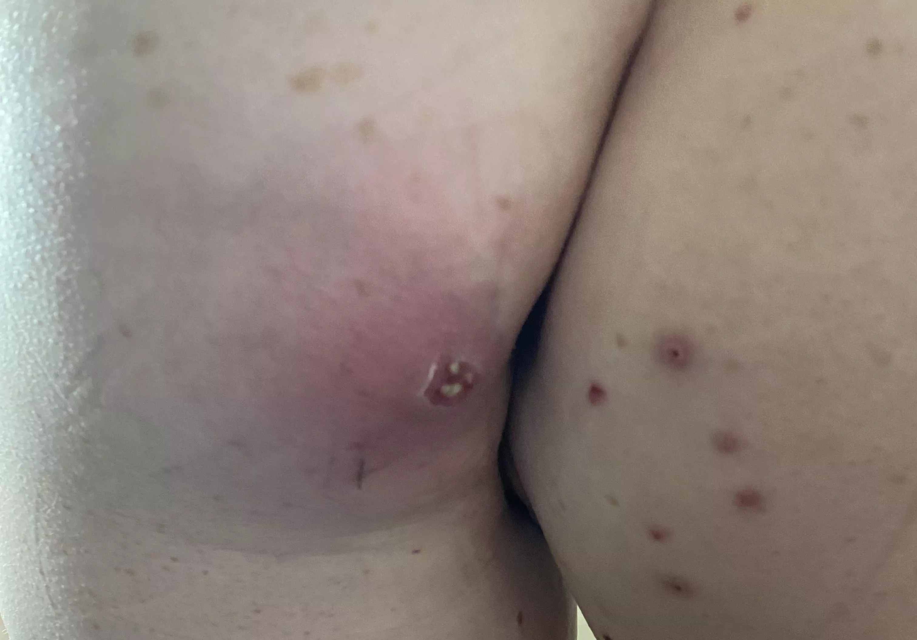 Carbuncle on butt ft. butt pimples posted by goofygirly1