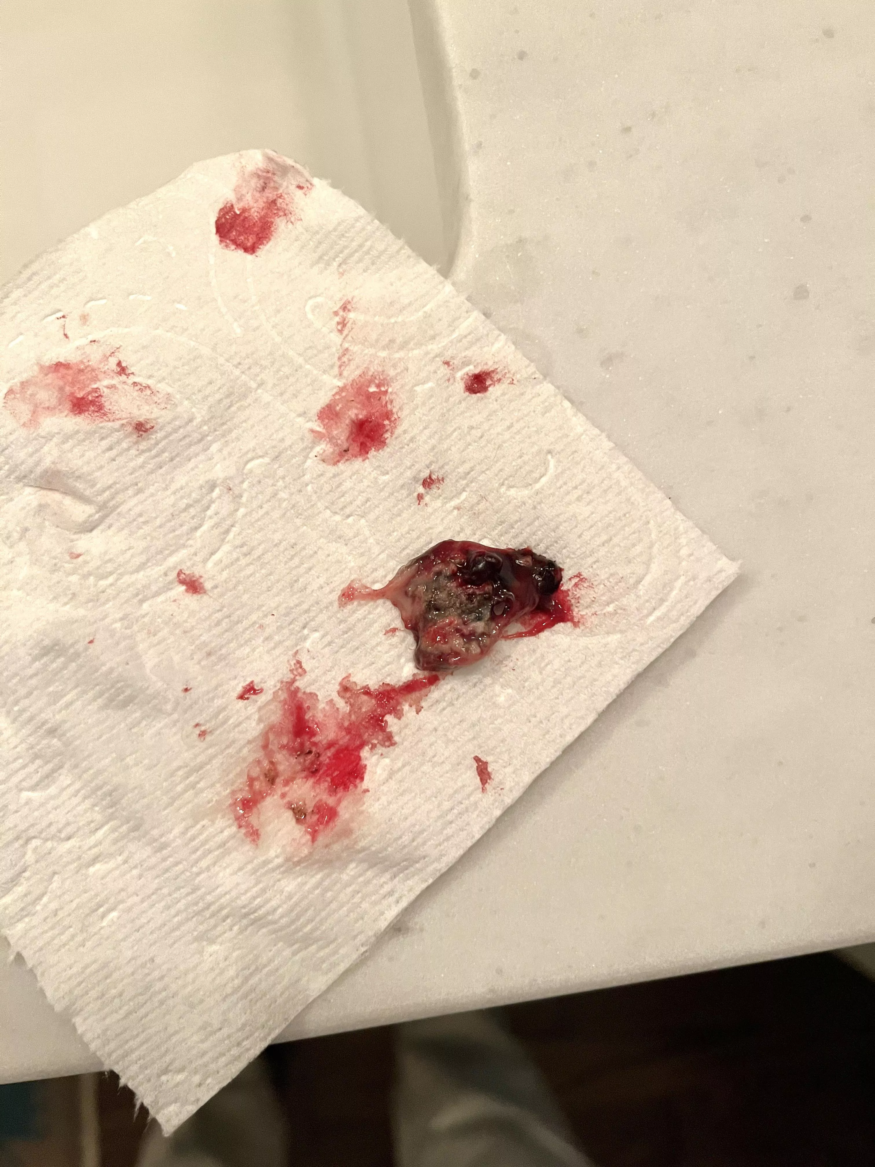 Coughed up this bad boy 12 days after my tonsillectomy. Waiting for the other shoe to drop now. posted by thehenrylong