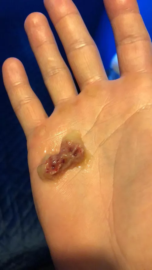 Couldn’t breathe for a couple of days until this came out of my nose.. by berries94