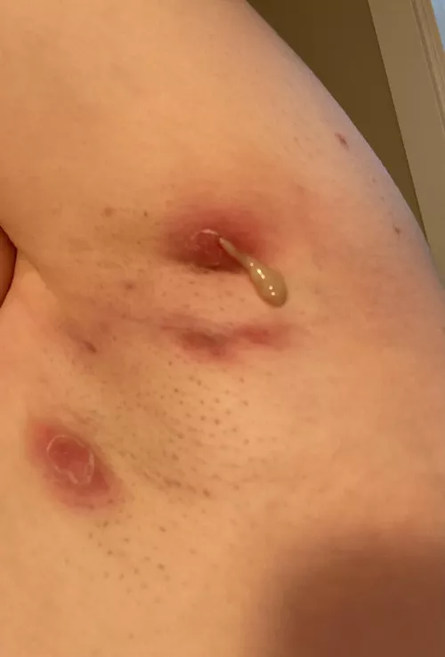 Currently in an HS flare up, this one popped… by NoxWillow