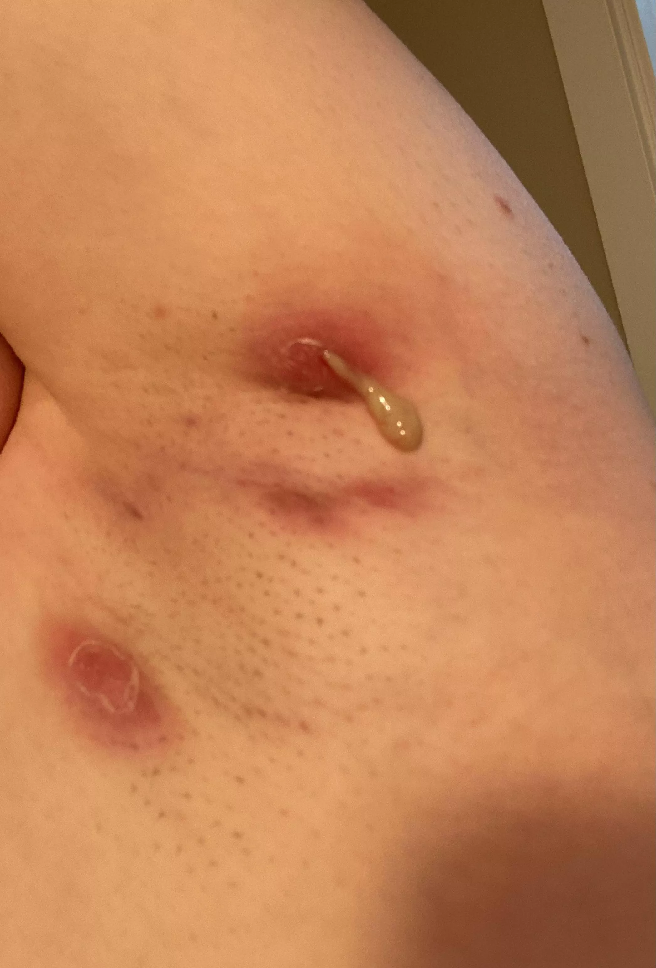 Currently in an HS flare up, this one popped… posted by NoxWillow