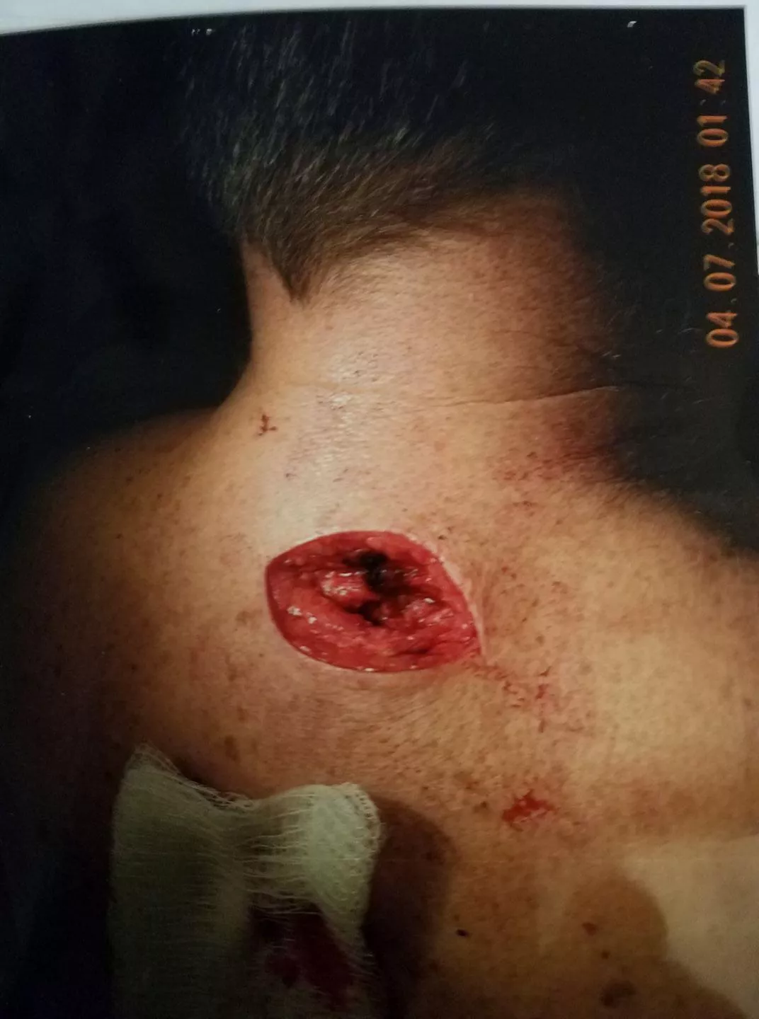 Dad’s lipoma removal posted by Mafistos