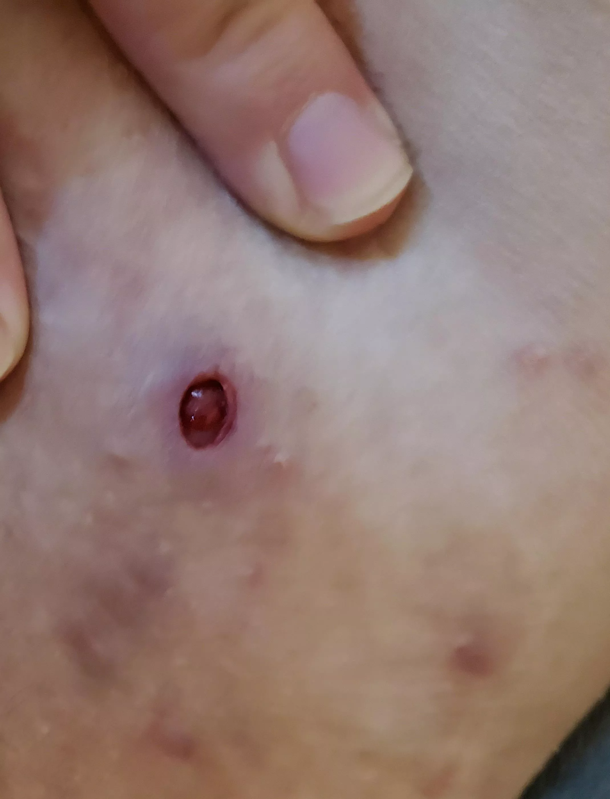 diagnosed with HS today, now my thighs are full of holes. posted by MiryndaSFHS