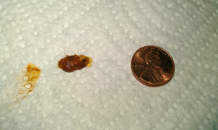 DIY Ear Wax Extraction by LokiNightmare