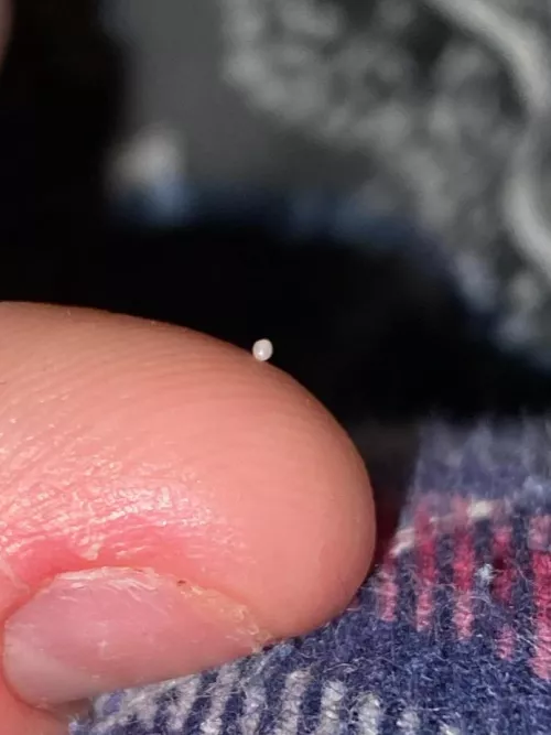 Does anyone know what this is? They keep showing up in my scars and i can pop them out of there. Are they cysts? by Significant-Age4280