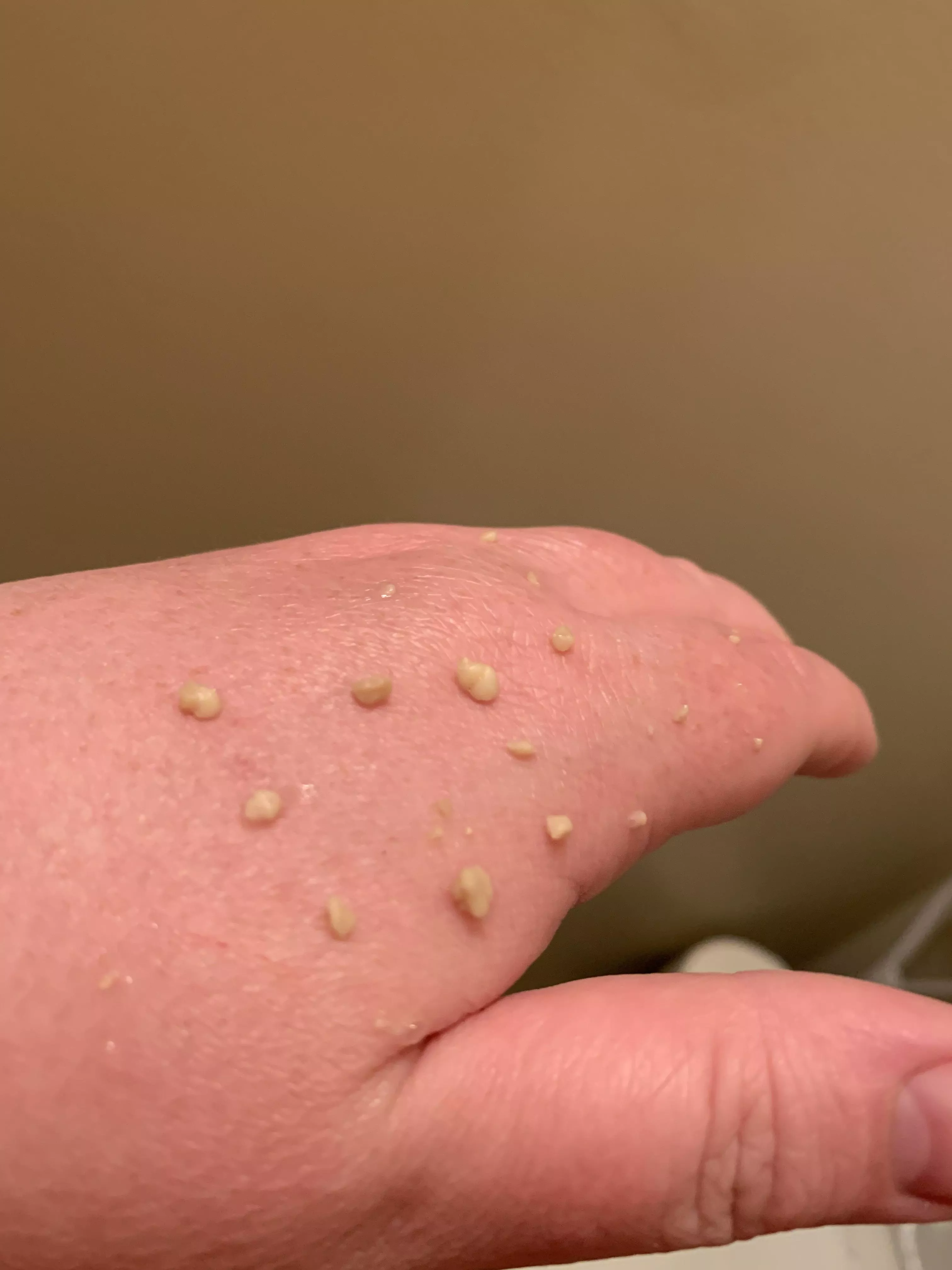 Dug these out of the left side of my throat and now I’m 10lbs lighter. posted by superdupershan