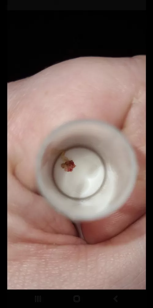 Ear Hole Update! it's been a few months, and all they've confirmed is that it IS a cholesteatoma...and a big one at that. Waiting for a pre-surgery consultation, but today a piece literally broke off in my ear causing quite a bit of bleeding and pain ð by Living-Ad-6751