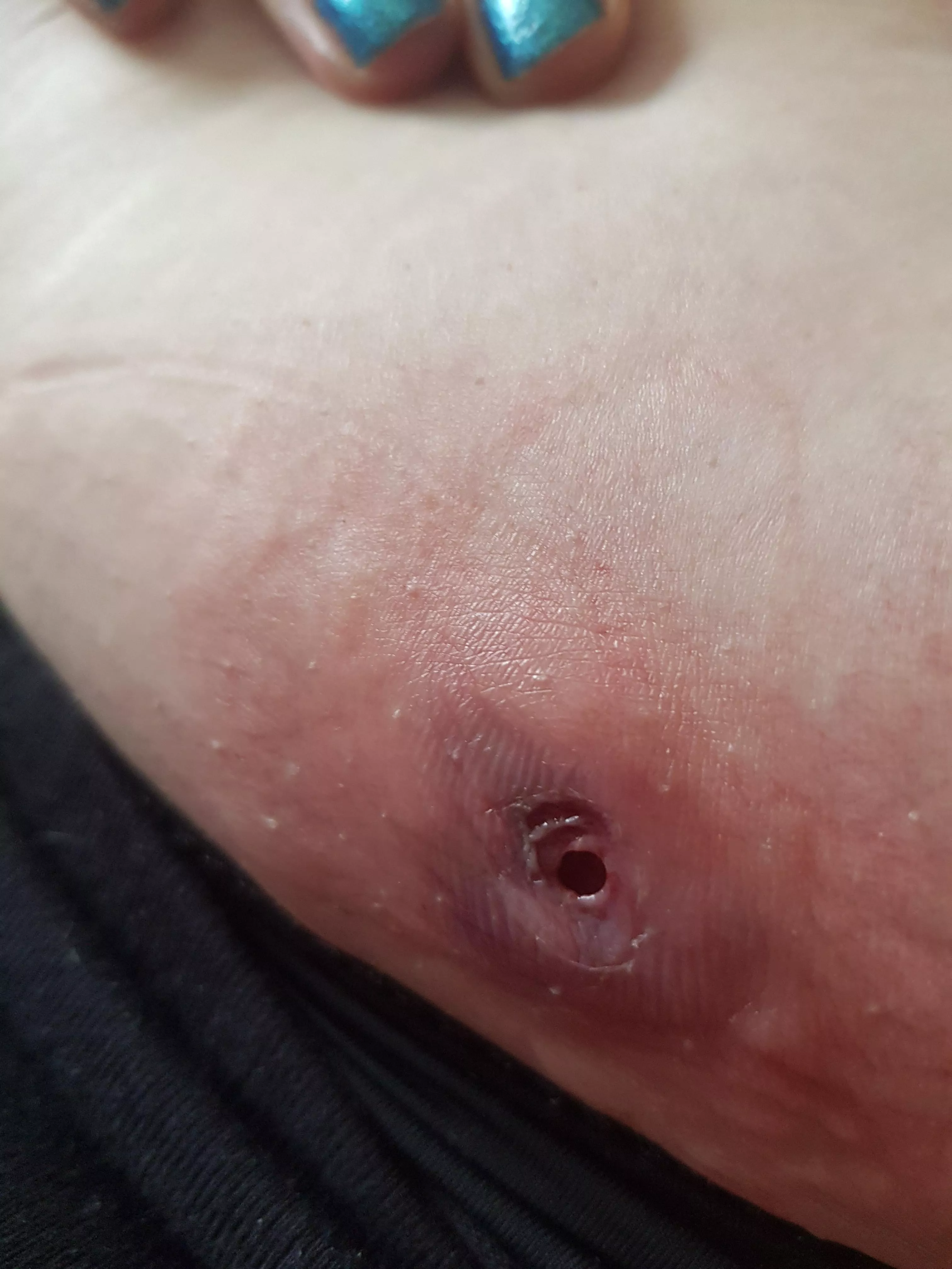 Enjoy my hole! doctor visit tomorrow. [oc] posted by Dollypunch