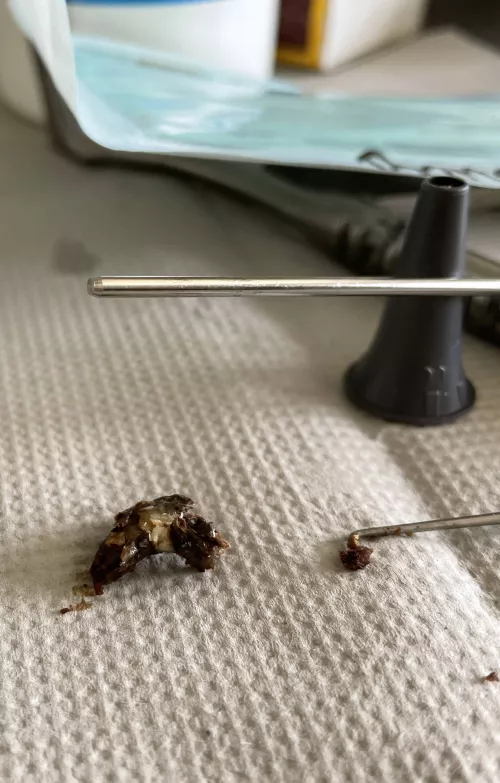 Extracted at the hospital. Now I can hear again. by LaBombonera