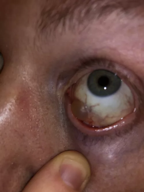 Eye doctor said this is a benign cyst on my eyeball. I’m popping this, right? by itisnear