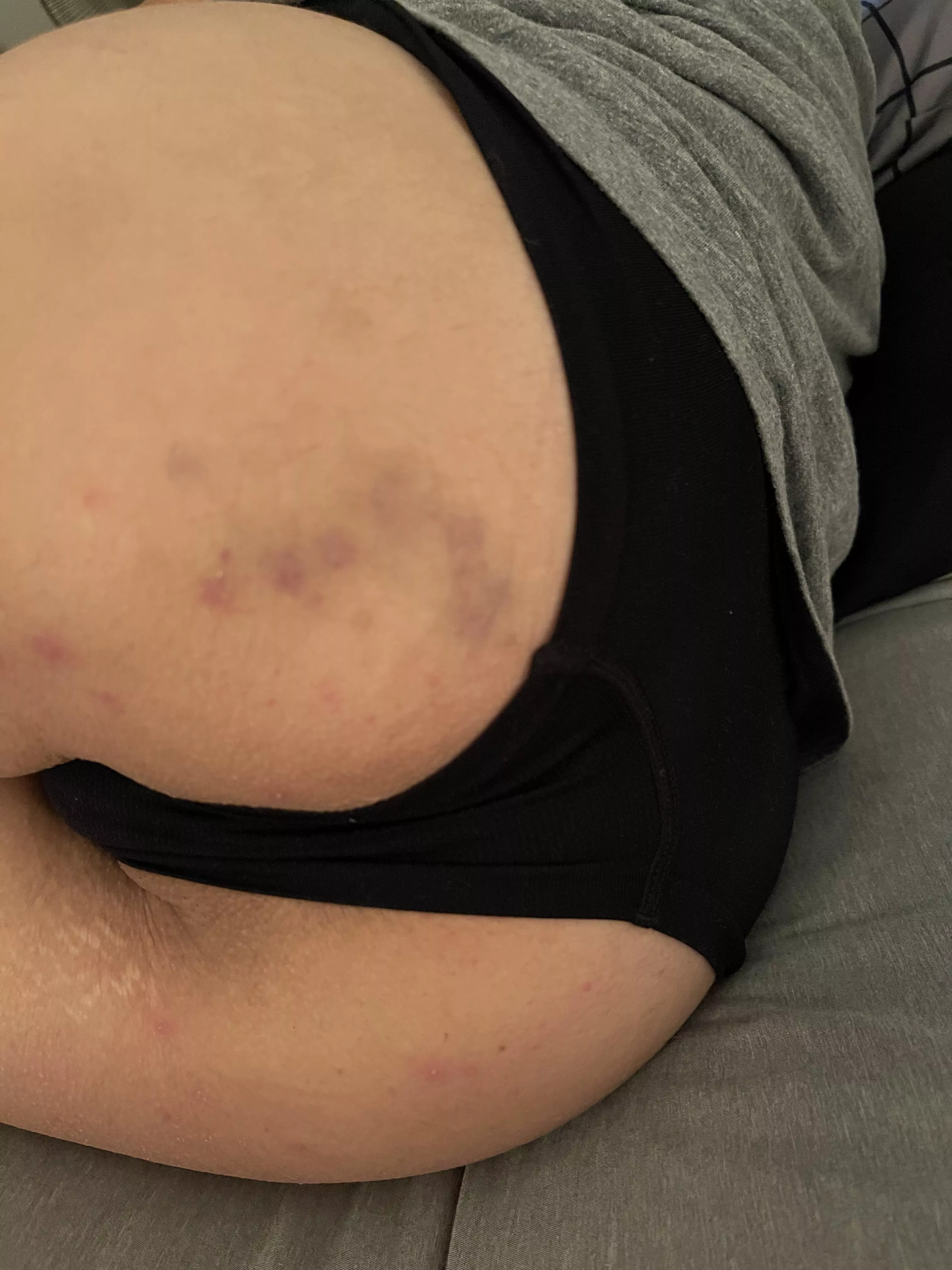 [f] Some of Babygirl’s bruises. posted by Babygirls_Sir
